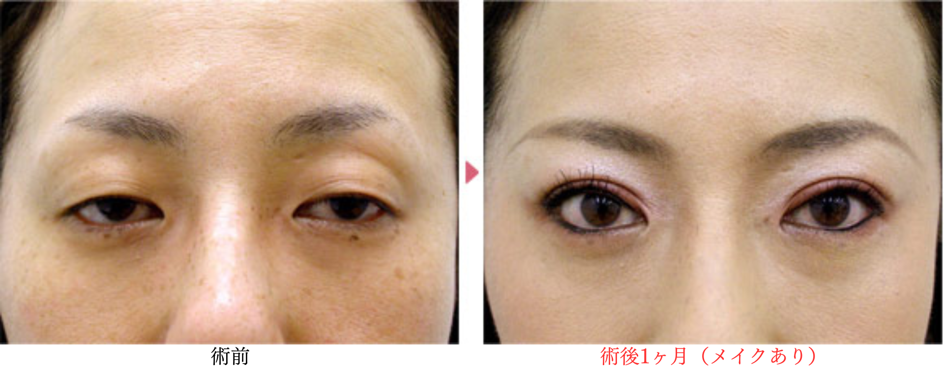 コンタクトレンズ性眼瞼下垂（48歳女性）