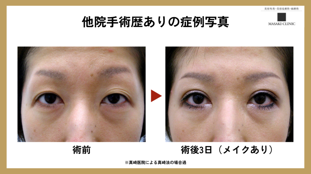他院修正ありの眼瞼下垂手術の症例写真