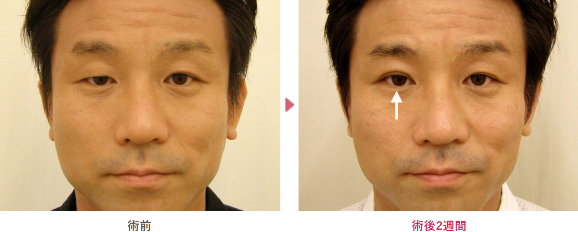 先天性眼瞼下垂の術前と術後2週間の見た目の変化を表す症例写真