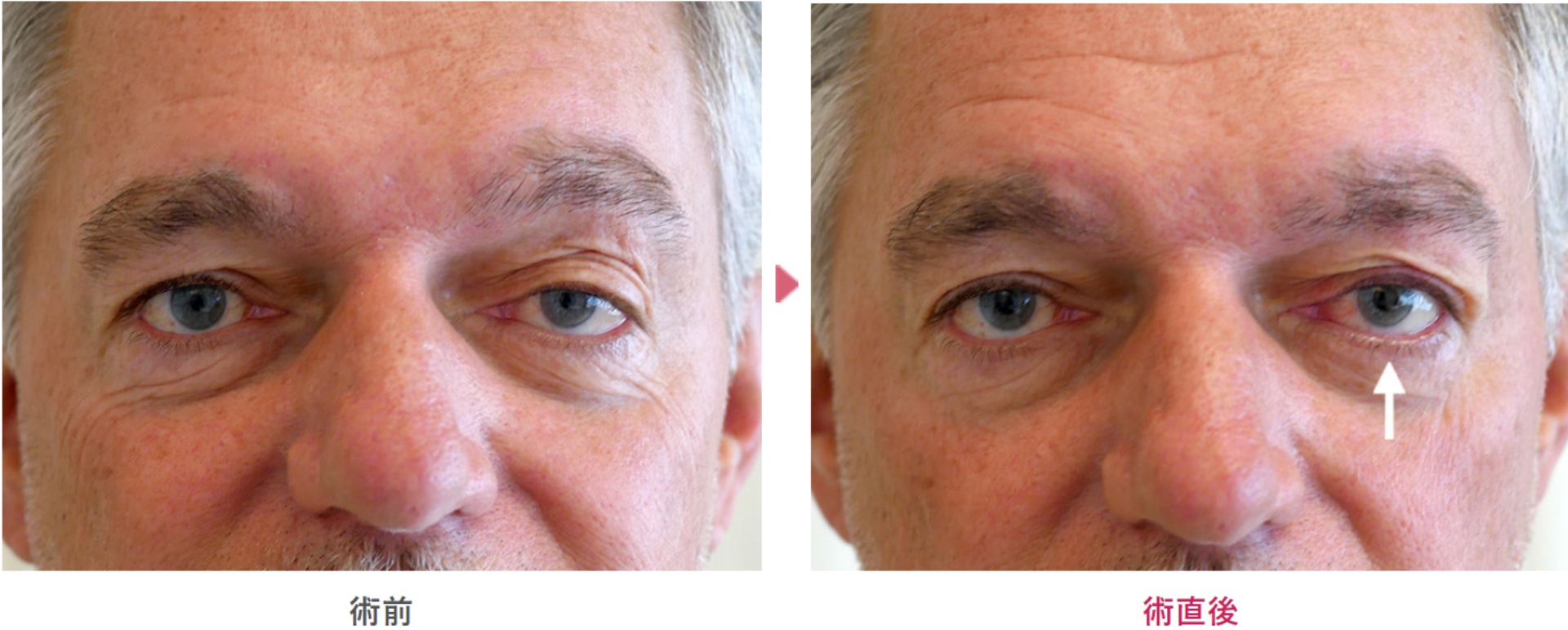 先天性眼瞼下垂症の術前と術後の見た目の変化を表す症例写真