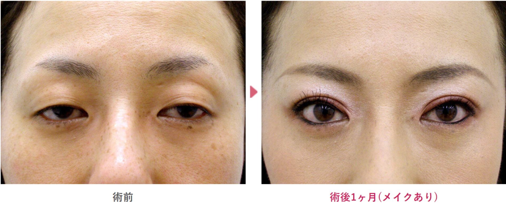 コンタクトレンズ性眼瞼下垂の術前と術後1ヶ月（メイクあり）の見た目の変化を表す症例写真
