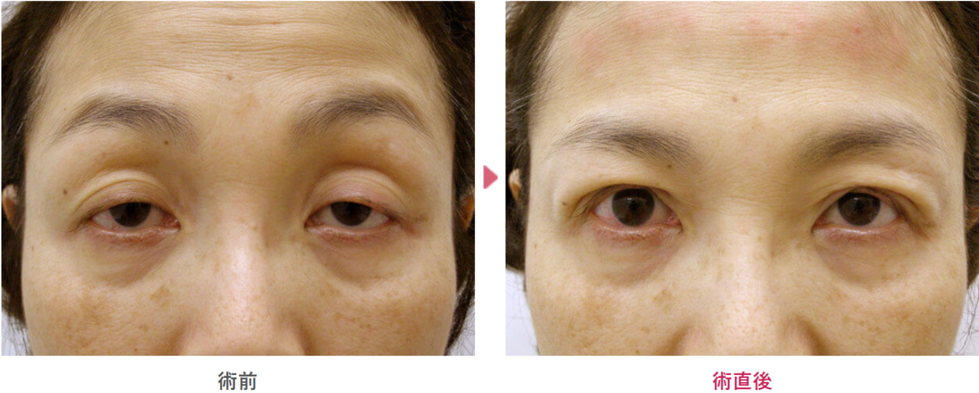 コンタクトレンズ性眼瞼下垂の術前と術直後の見た目の変化を表す症例写真