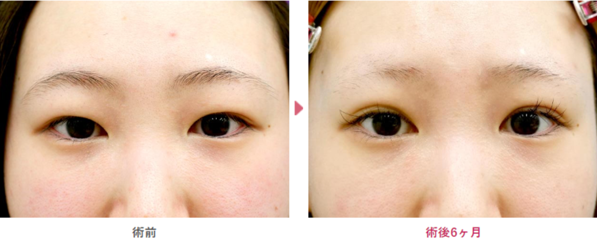 二重切開の術前と術後6ヶ月の見た目の変化を表す症例写真