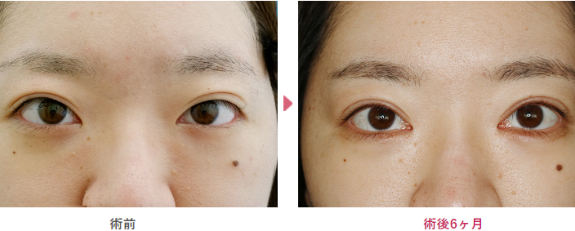 二重切開と目頭切開手術の術前と術直6ヶ月の見た目の変化を表す症例写真