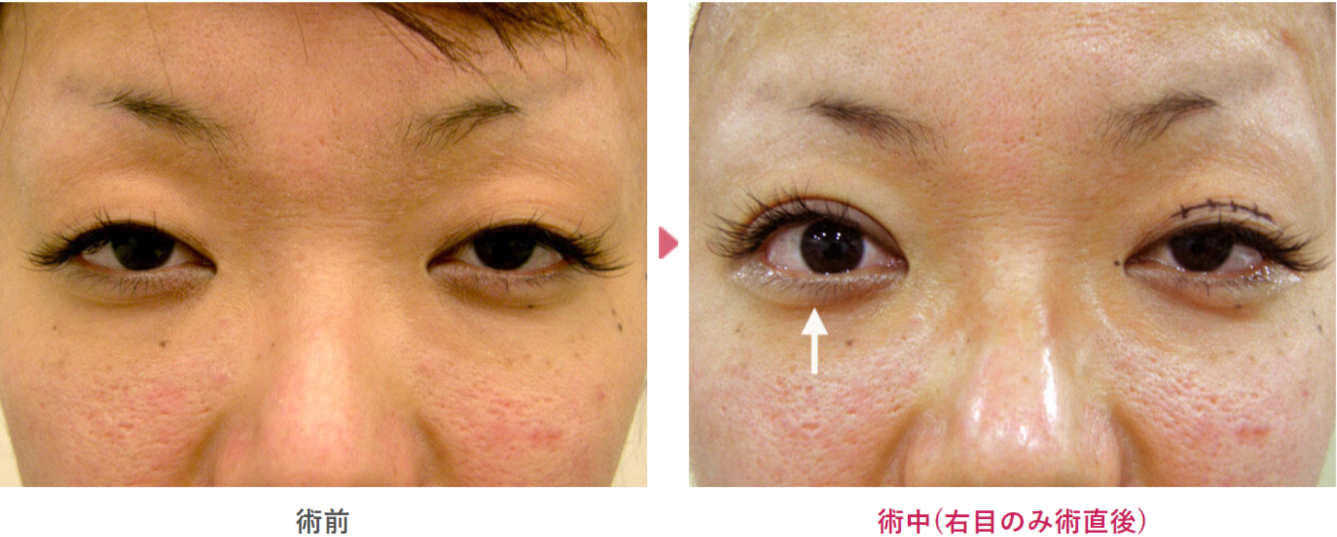 二重と眼瞼下垂治療を受け術前と術中の見た目の変化を表す症例写真