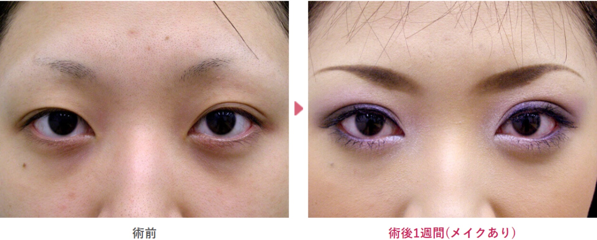 他院修正の二重埋没治療の術前と術後1週間（メイクあり）の見た目の変化を表す症例写真