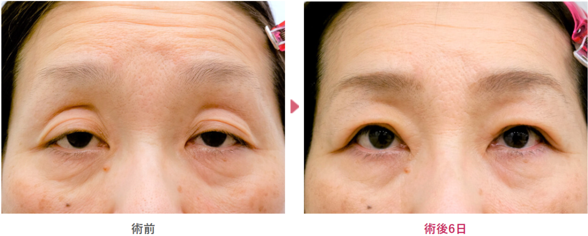 重度の後天性眼瞼下垂症の術前と術後6日目の見た目の変化を表す症例写真