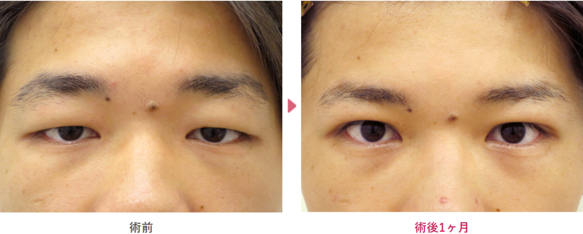 皮膚や脂肪が厚い二重埋没法の術前と術後1ヶ月の見た目の変化を表す症例写真