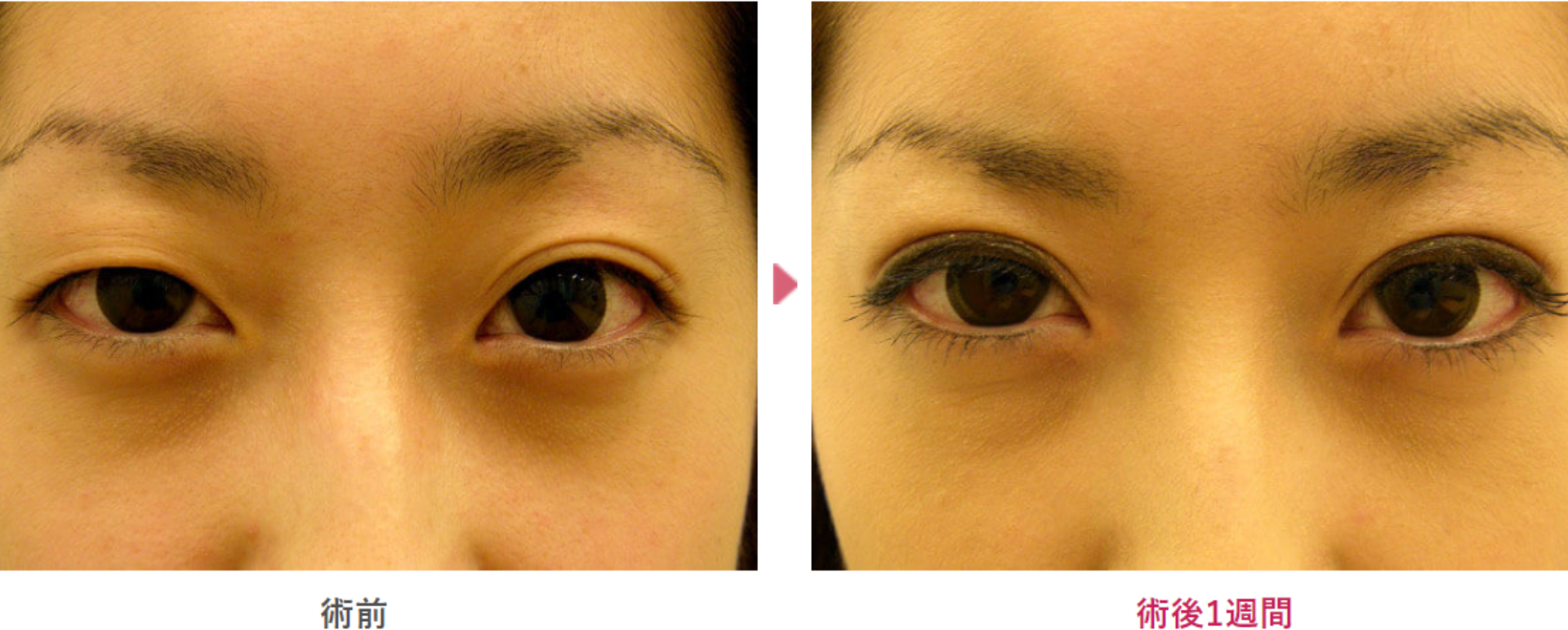 幅広二重埋没の術前と術後1週間（メイクあり）の見た目の変化を表す症例写真