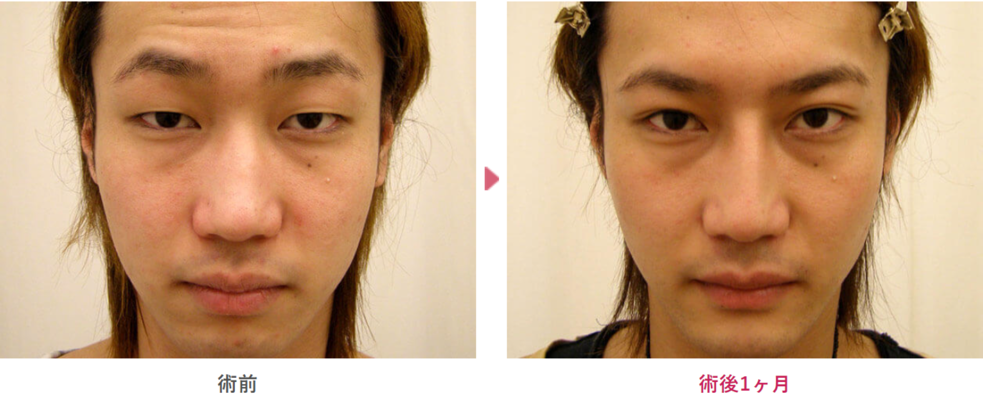 切らない眼瞼下垂の術前と術後1ヶ月の見た目の変化を表す症例写真